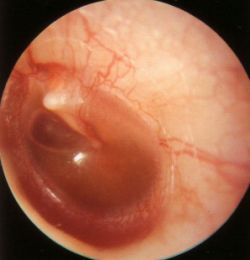 Otita medie cum afectează vederea, Infecția urechii (urechea medie) - bufetto.ro